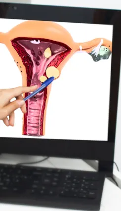 A hand pointing to a uterus anatomy diagram displayed on a computer monitor.