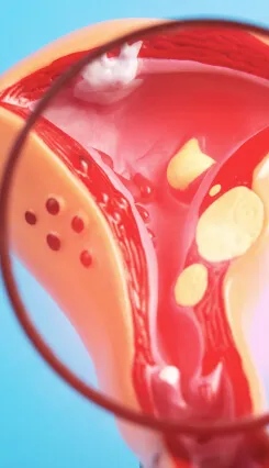 A medical illustration of a uterus showing fibroids viewed through a magnifying glass.