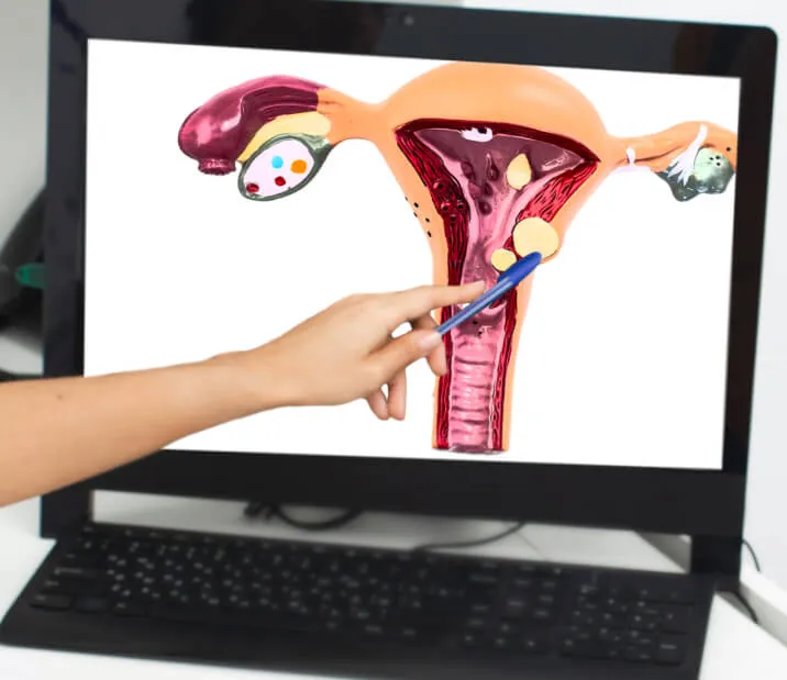 A hand pointing to a uterus illustration displayed on a computer monitor.